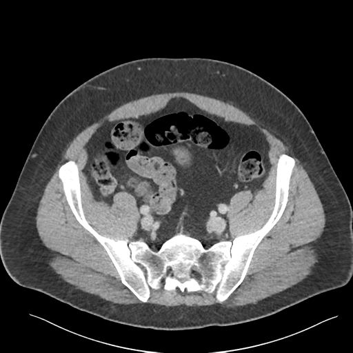 Adrenal cyst (Radiopaedia 45625-49777 Axial C+ portal venous phase 78).png