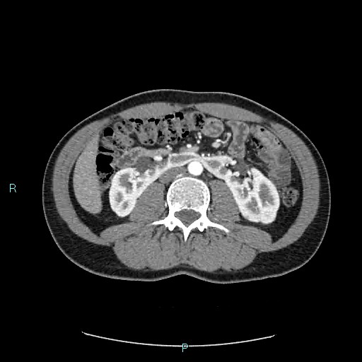 Adrenal cystic lymphangioma (Radiopaedia 83161-97534 Axial C+ arterial phase 47).jpg