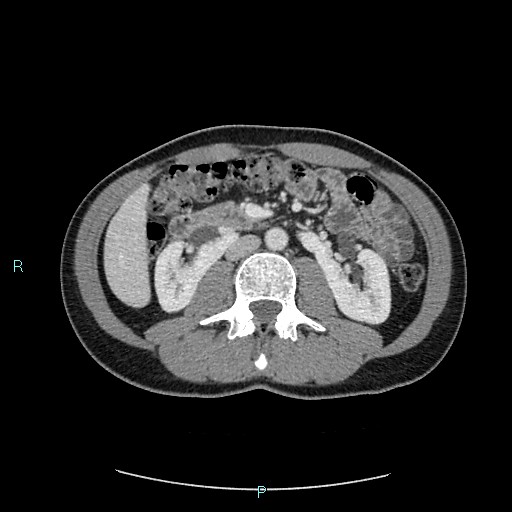 Adrenal cystic lymphangioma (Radiopaedia 83161-97534 Axial C+ portal venous phase 45).jpg