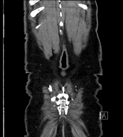 Adrenal lymphoma (Radiopaedia 73730-84529 Coronal C+ portal venous phase 77).jpg