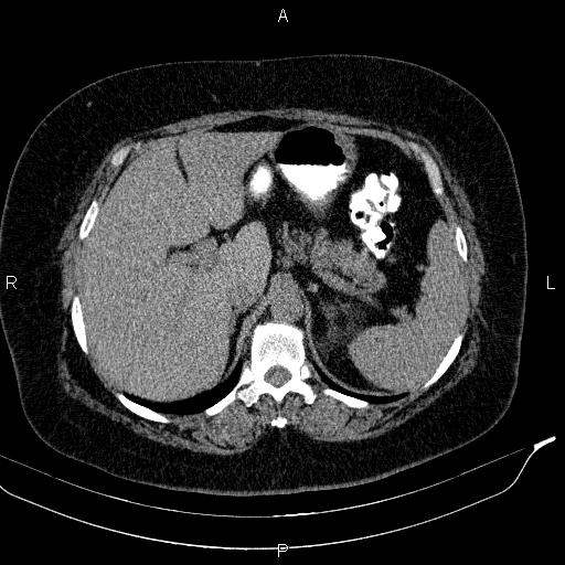 File:Adrenal myelolipoma (Radiopaedia 84319-99617 Axial With oral contrast 56).jpg