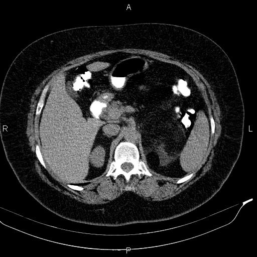 Adrenal myelolipoma (Radiopaedia 84319-99617 Axial With oral contrast 70).jpg