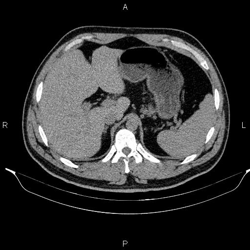 Adrenal myelolipoma (Radiopaedia 84321-99619 Axial non-contrast 28).jpg