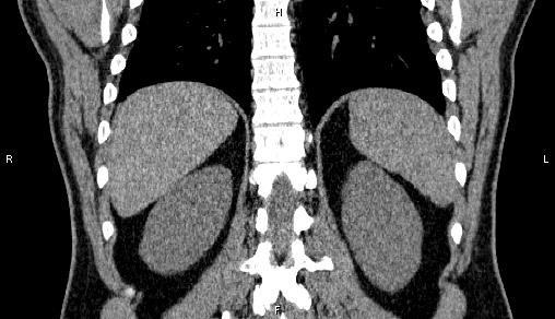 Adrenal myelolipoma (Radiopaedia 84321-99619 Coronal non-contrast 60).jpg
