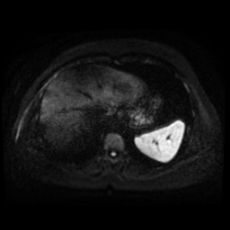 File:Adrenal myelolipoma - MRI (Radiopaedia 83249-97646 Axial DWI 4).jpg