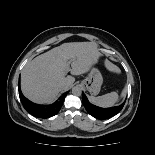 Adrenal myelolipoma and beaver tail liver (Radiopaedia 86201-102193 Axial non-contrast 80).jpg