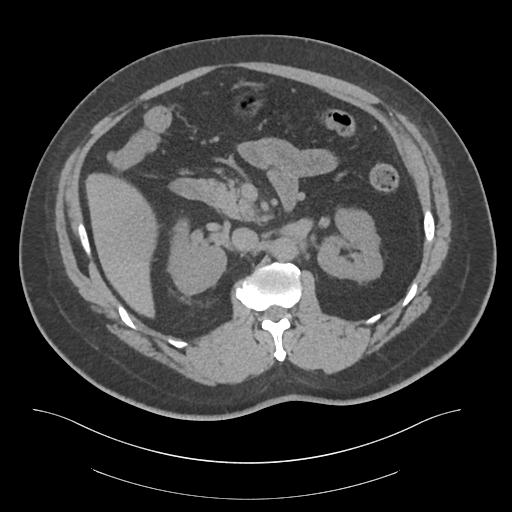 File:Adrenal vein sampling and adrenal nodular hyperplasia - Conn syndrome (Radiopaedia 30561-31337 Axial non-contrast 33).jpg
