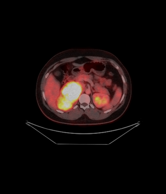 Adrenocortical carcinoma (Radiopaedia 80134-93440 ِAxial 164).jpg