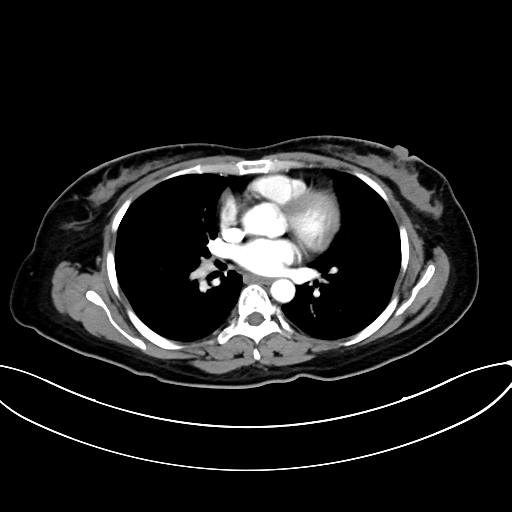 Adrenocortical carcinoma (Radiopaedia 87281-103569 Axial C+ arterial phase 2).jpg