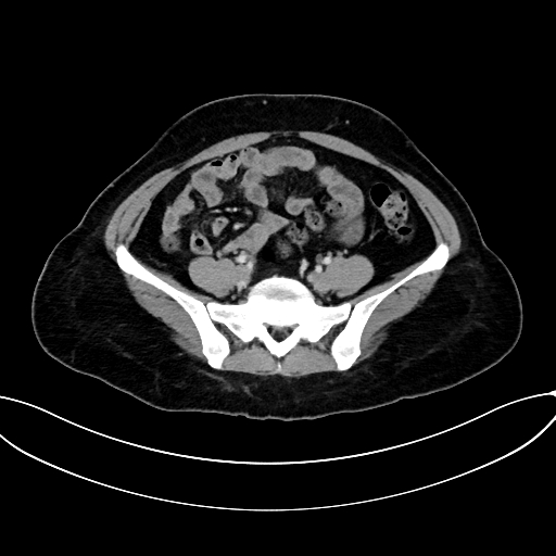 Adrenocortical carcinoma (Radiopaedia 87281-103569 Axial C+ portal venous phase 62).jpg