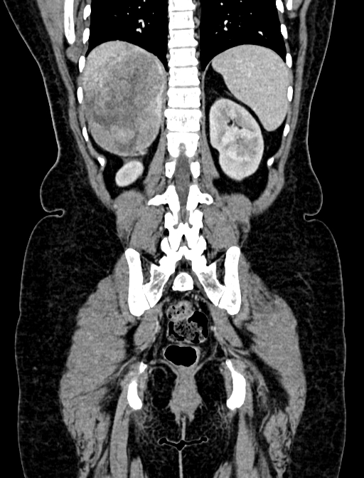 Adrenocortical carcinoma (Radiopaedia 87281-103569 Coronal C+ portal venous phase 104).jpg