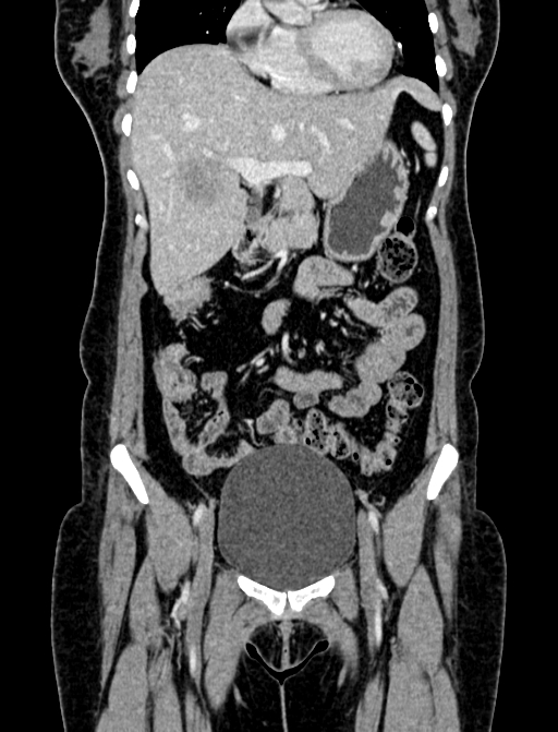 Adrenocortical carcinoma (Radiopaedia 87281-103569 Coronal C+ portal venous phase 4).jpg