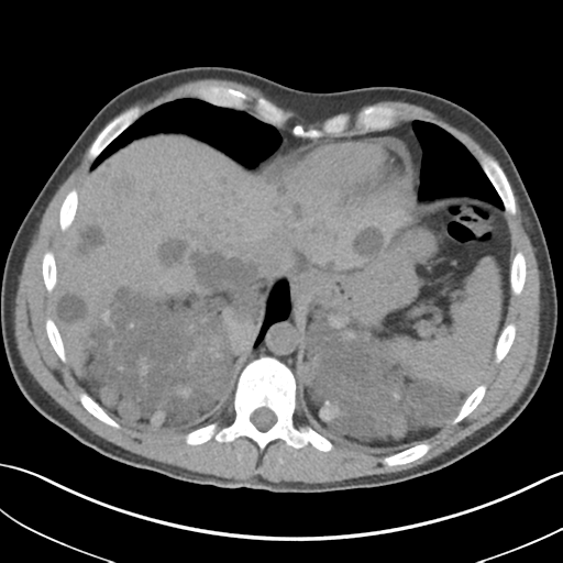 File:Adult polycystic kidney disease (Radiopaedia 47866-52626 Axial non-contrast 11).png
