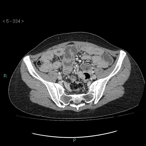Adult transient intestinal intussusception (Radiopaedia 34853-36310 Axial C+ portal venous phase 82).jpg