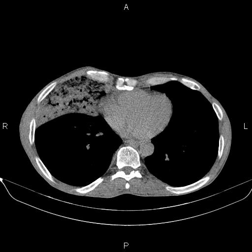 Air bronchogram in pneumonia (Radiopaedia 85719-101512 Axial non-contrast 46).jpg