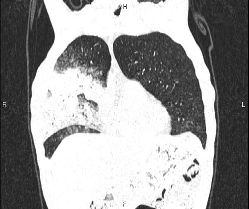 Air bronchogram in pneumonia (Radiopaedia 85719-101512 Coronal lung window 14).jpg