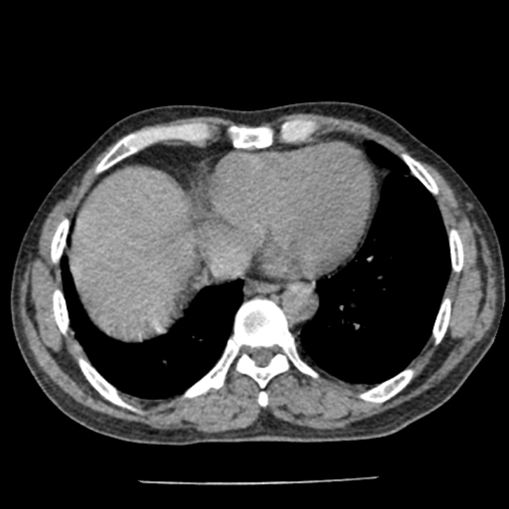 Airway foreign body in adult (Radiopaedia 85907-101779 Axial liver window 135).jpg