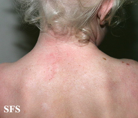 Albinism (Dermatology Atlas 4).jpg