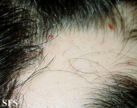 Alopecia Areata (Dermatology Atlas 20).jpg