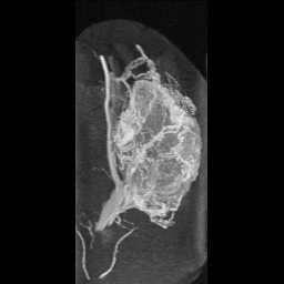 Alveolar soft part sarcoma (Radiopaedia 64501-73678 D 16).jpg