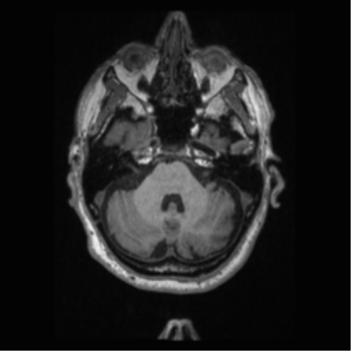 File:Alzheimer disease - probable (Radiopaedia 35334-36837 Axial T1 22).png