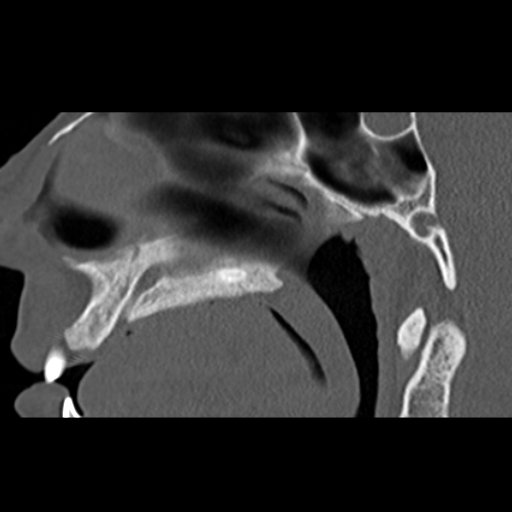 File:Ameloblastic fibro-odontoma (Radiopaedia 18843-18780 bone window 1).jpg
