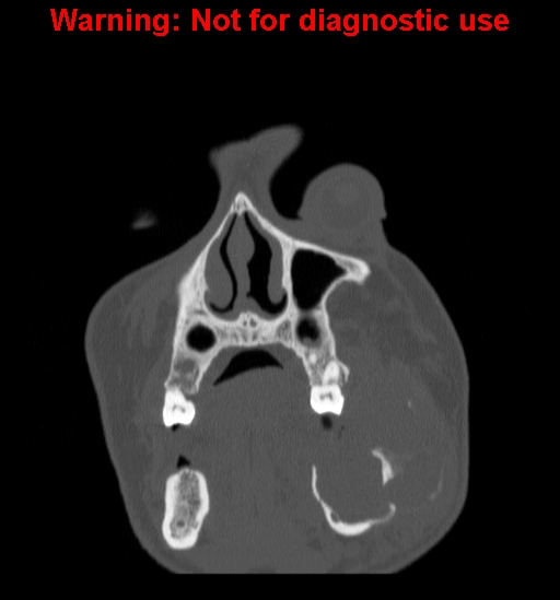 File:Ameloblastoma (Radiopaedia 13276-13280 Coronal non-contrast 4).jpg