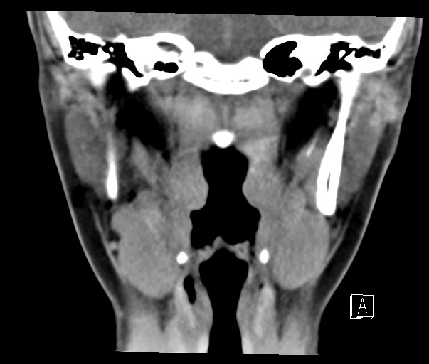 File:Ameloblastoma (Radiopaedia 26645-26793 Coronal C+ delayed 14).jpg