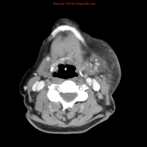 Ameloblastoma (Radiopaedia 27437-27631 A 55).jpg