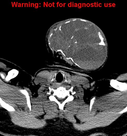 File:Ameloblastoma (Radiopaedia 33126-34164 A 29).jpg