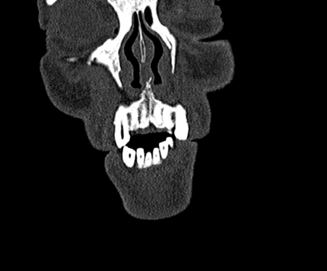 Ameloblastoma (Radiopaedia 51921-57766 Coronal bone window 18).jpg
