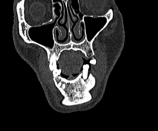 Ameloblastoma (Radiopaedia 51921-57766 Coronal bone window 43).jpg