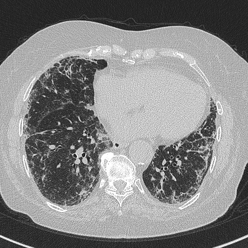 Amiodarone-induced pulmonary fibrosis (Radiopaedia 82355-96460 Axial lung window 47).jpg