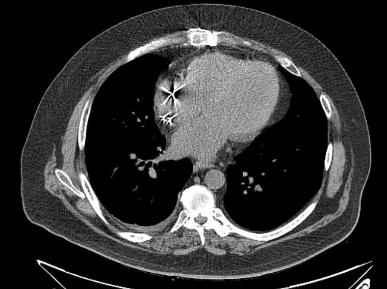 Amiodarone lung (Radiopaedia 62514-70769 Axial non-contrast 56).jpg