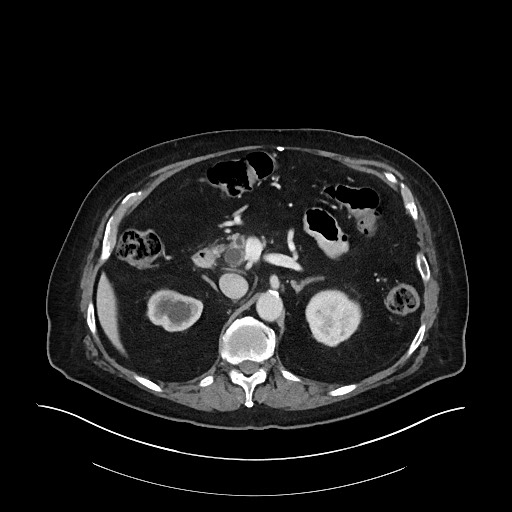 Ampullary adenocarcinoma (Radiopaedia 59373-66734 C 56).jpg