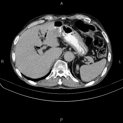 Ampullary adenocarcinoma (Radiopaedia 86093-102033 Axial C+ delayed 25).jpg