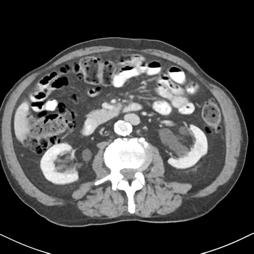 File:Amyand hernia (Radiopaedia 39300-41547 A 30).png