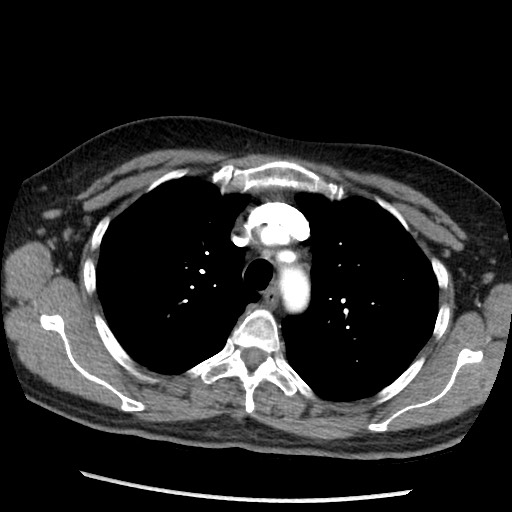 Amyloidosis - bronchial and diffuse nodular pulmonary involvement (Radiopaedia 60156-67745 A 14).jpg