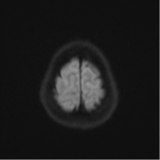 Anaplastic astroblastoma (Radiopaedia 55666-62194 Axial DWI 54).png