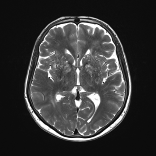 File:Anaplastic astrocytoma (Radiopaedia 86943-103160 Axial T2 20).png