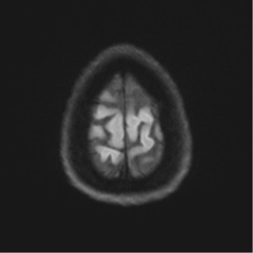 Anaplastic astrocytoma - thalamic glioma (Radiopaedia 59709-67115 Axial DWI 67).png