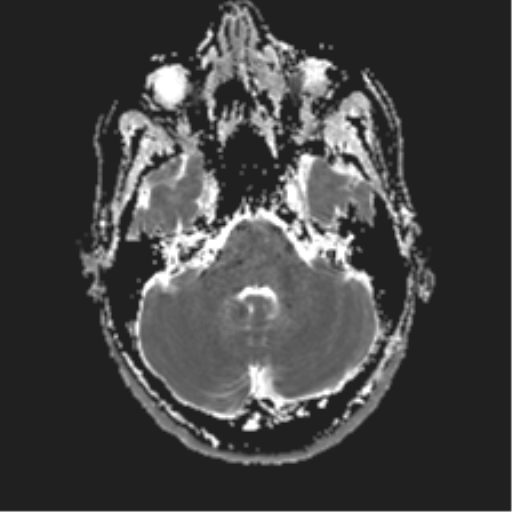 File:Anaplastic astrocytoma IDH mutant (Radiopaedia 50046-55341 Axial ADC 7).png