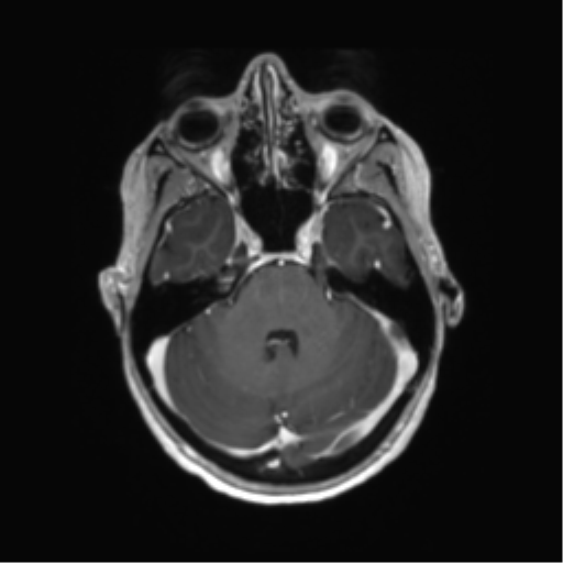File:Anaplastic astrocytoma IDH mutant (Radiopaedia 50046-55341 Axial T1 C+ 15).png