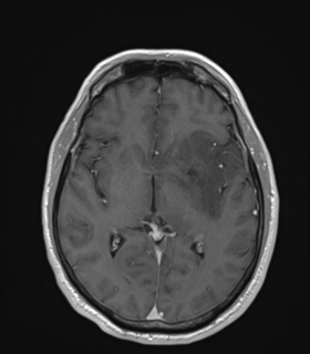 File:Anaplastic astrocytoma IDH wild-type (Radiopaedia 49984-55273 Axial T1 C+ 29).png