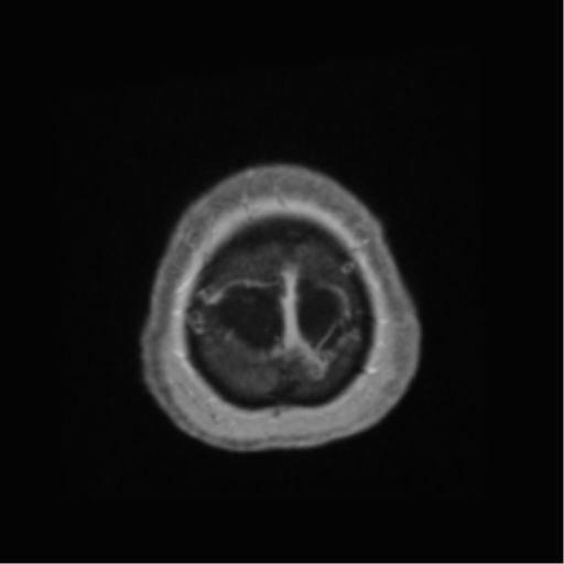 Anaplastic astrocytoma IDH wild-type (pseudoprogression) (Radiopaedia 42209-45278 Axial T1 C+ 146).png