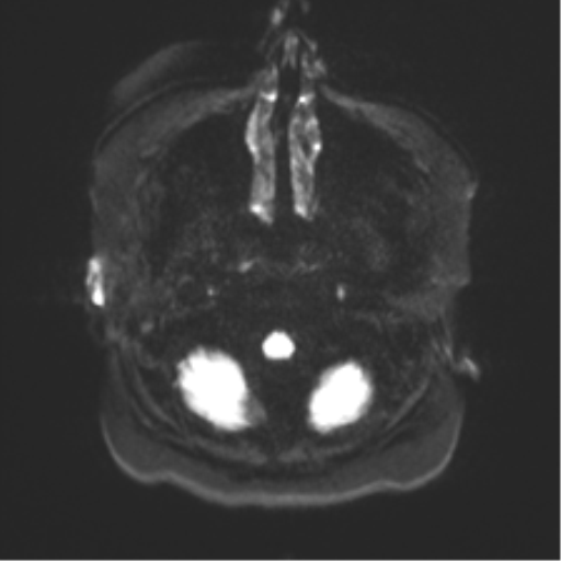 File:Anaplastic astrocytoma IDH wild-type (pseudoprogression) (Radiopaedia 42209-45279 Axial DWI 29).png