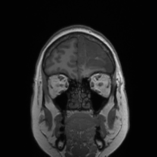 Anaplastic oligodendroglioma (Radiopaedia 83500-98599 Coronal T1 82).png