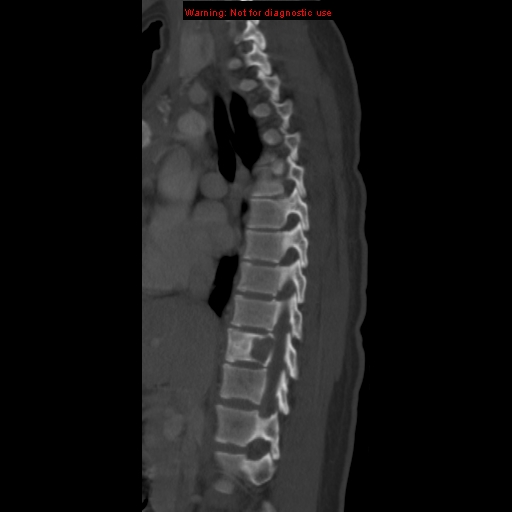 File:Aneurysmal bone cyst (Radiopaedia 9419-10102 Sagittal bone window 4).jpg