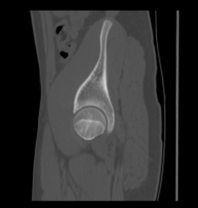 Aneurysmal bone cyst of ischium (Radiopaedia 25957-26094 Sagittal bone window 57).png