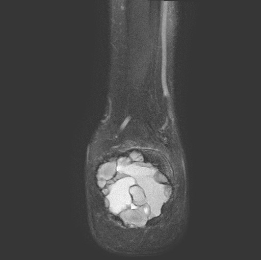File:Aneurysmal bone cyst of the calcaneus (Radiopaedia 60669-68420 Coronal T2 fat sat 22).jpg